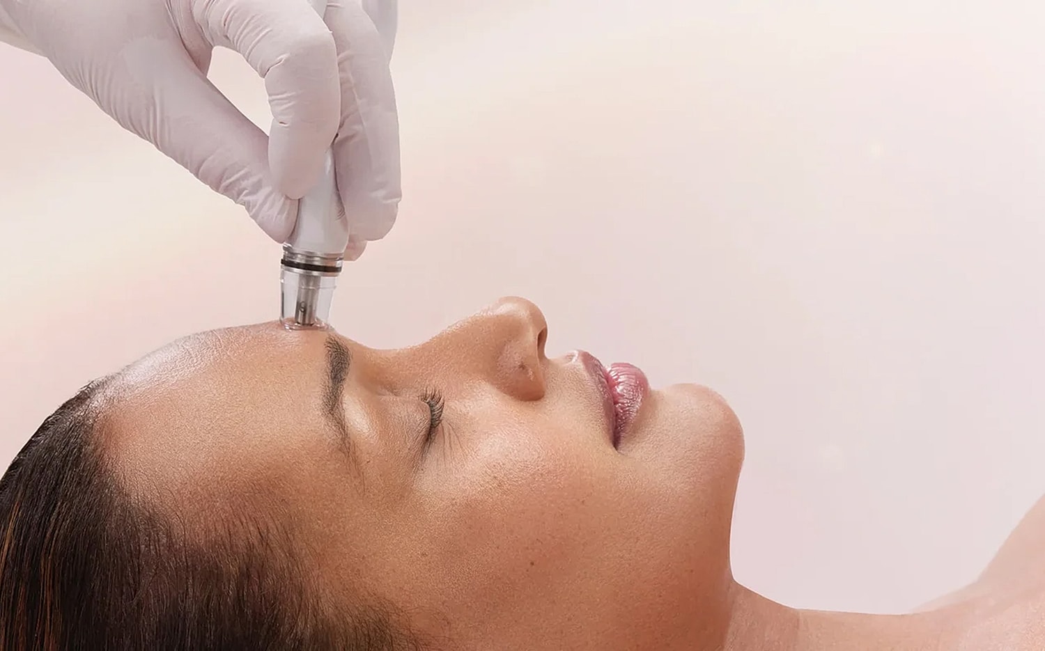 Microneedling facial treatment in progress.