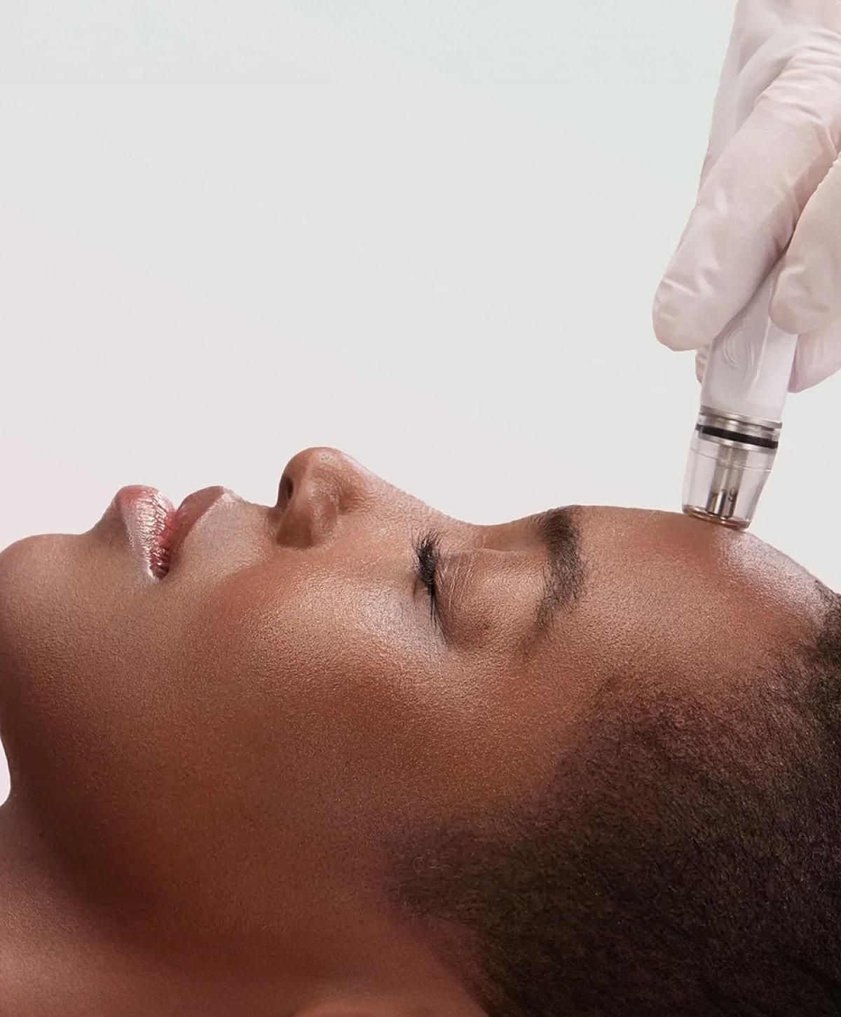 Microneedling treatment on a woman's forehead.