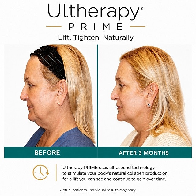 Ultherapy Prime before and after transformation